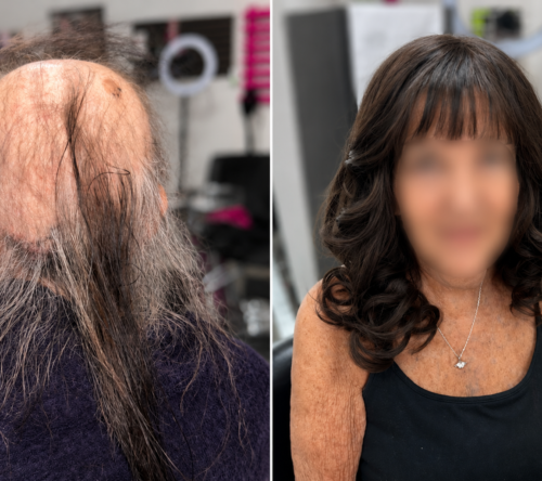 Before and after mesh integration hair loss transformation by LTBHair, a Hair Loss Specialist in Phoenix, Arizona.