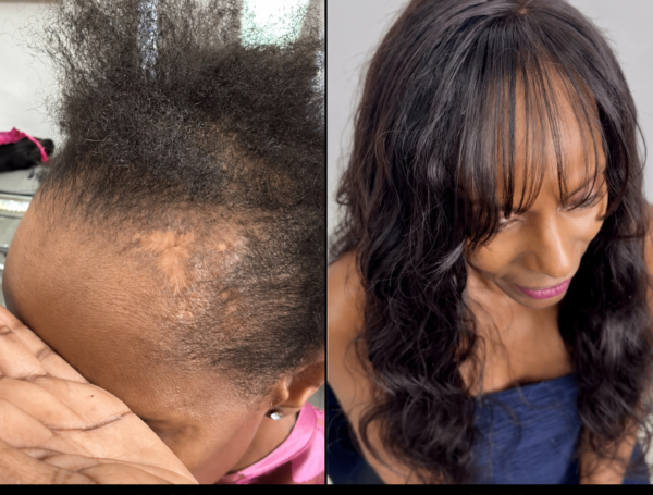 Custom Hybrid Hair Extensions Before and After Phoenix Before and after custom hybrid hair extensions for temple thinning and hairline coverage in Phoenix