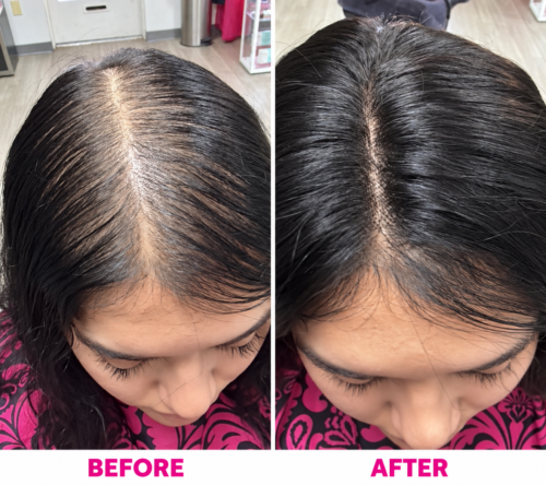 Meshless hair integration before and after Before and after meshless hair integration for crown thinning and widening part coverage