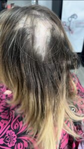 Client with scalp scarring and hair loss before a customized hair extension solution in Phoenix
